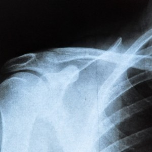 clavicula